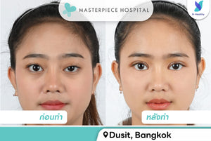 PTOSIS Correction